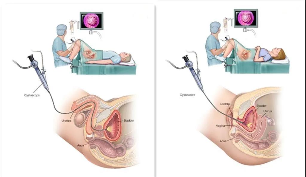膀胱镜取支架示意图图片
