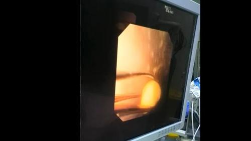 输尿管软镜有什么品牌【镜无止境】国产电子输尿管软镜的优势_https://www.jmylbn.com_新闻资讯_第5张