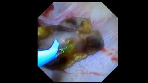 输尿管软镜有什么品牌【镜无止境】国产电子输尿管软镜的优势_https://www.jmylbn.com_新闻资讯_第6张