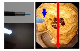 输尿管镜都有哪些公司【镜无止境】输尿管软镜操作的步骤和窍门_https://www.jmylbn.com_新闻资讯_第3张