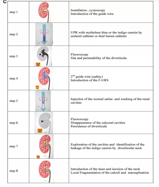 输尿管镜都有哪些公司【镜无止境】输尿管软镜操作的步骤和窍门_https://www.jmylbn.com_新闻资讯_第10张