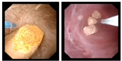 输尿管镜都有哪些公司【镜无止境】输尿管软镜操作的步骤和窍门_https://www.jmylbn.com_新闻资讯_第6张