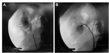 输尿管镜都有哪些公司【镜无止境】输尿管软镜操作的步骤和窍门_https://www.jmylbn.com_新闻资讯_第9张