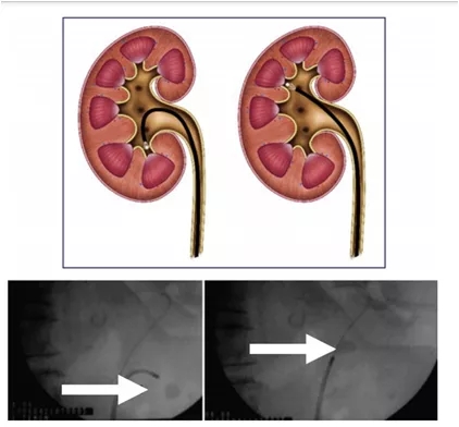 输尿管镜都有哪些公司【镜无止境】输尿管软镜操作的步骤和窍门_https://www.jmylbn.com_新闻资讯_第8张
